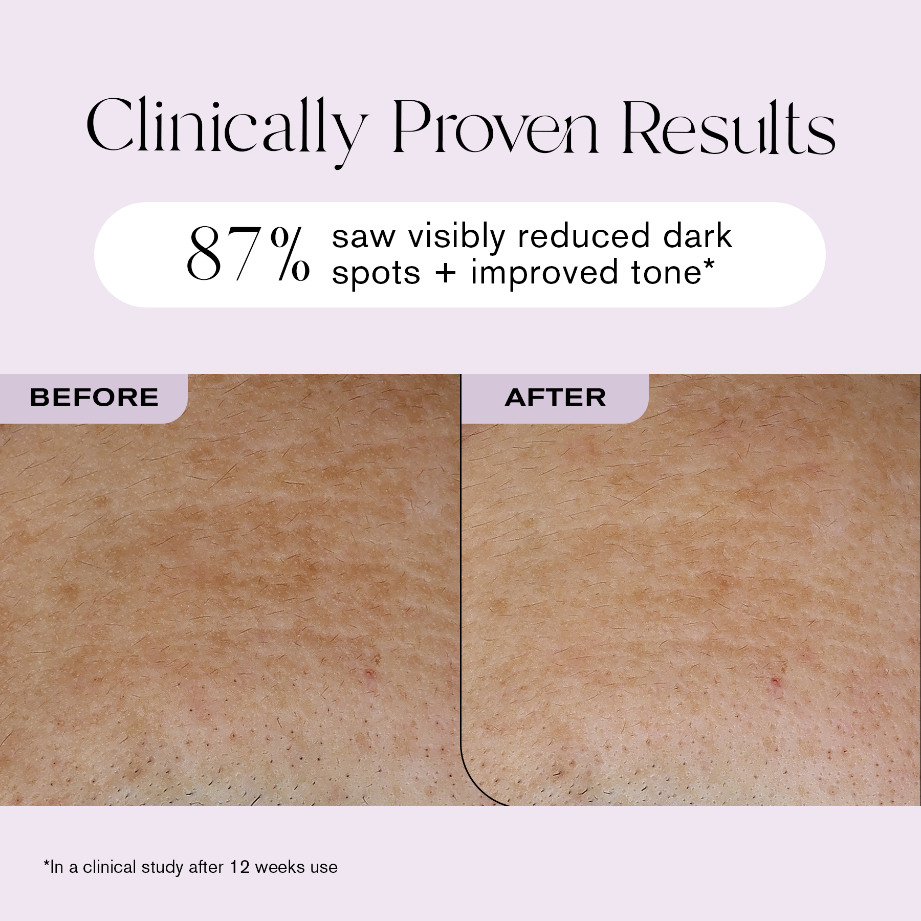 Clinically Proven Resuts
87% saw visibly reduced dark spots + improved tone*
*In a clinical study after 12 weeks of use.