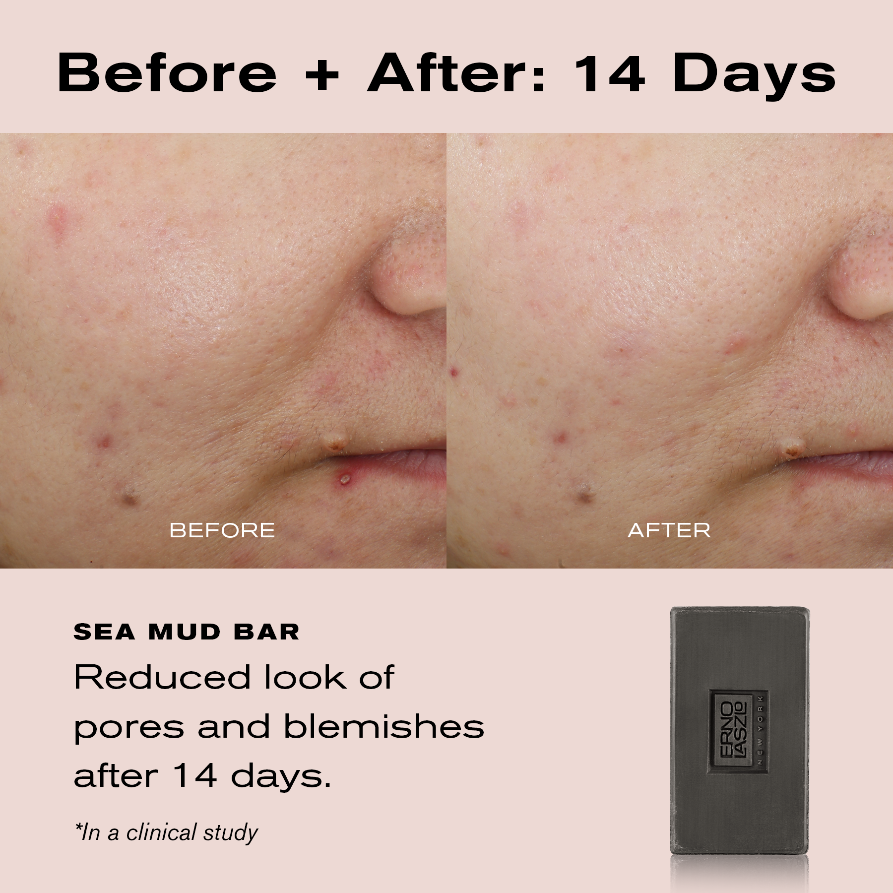 Before + After: 14 Days
Sea Mud Bar reduced look of blemishes after 14 days.
*In a clinical study