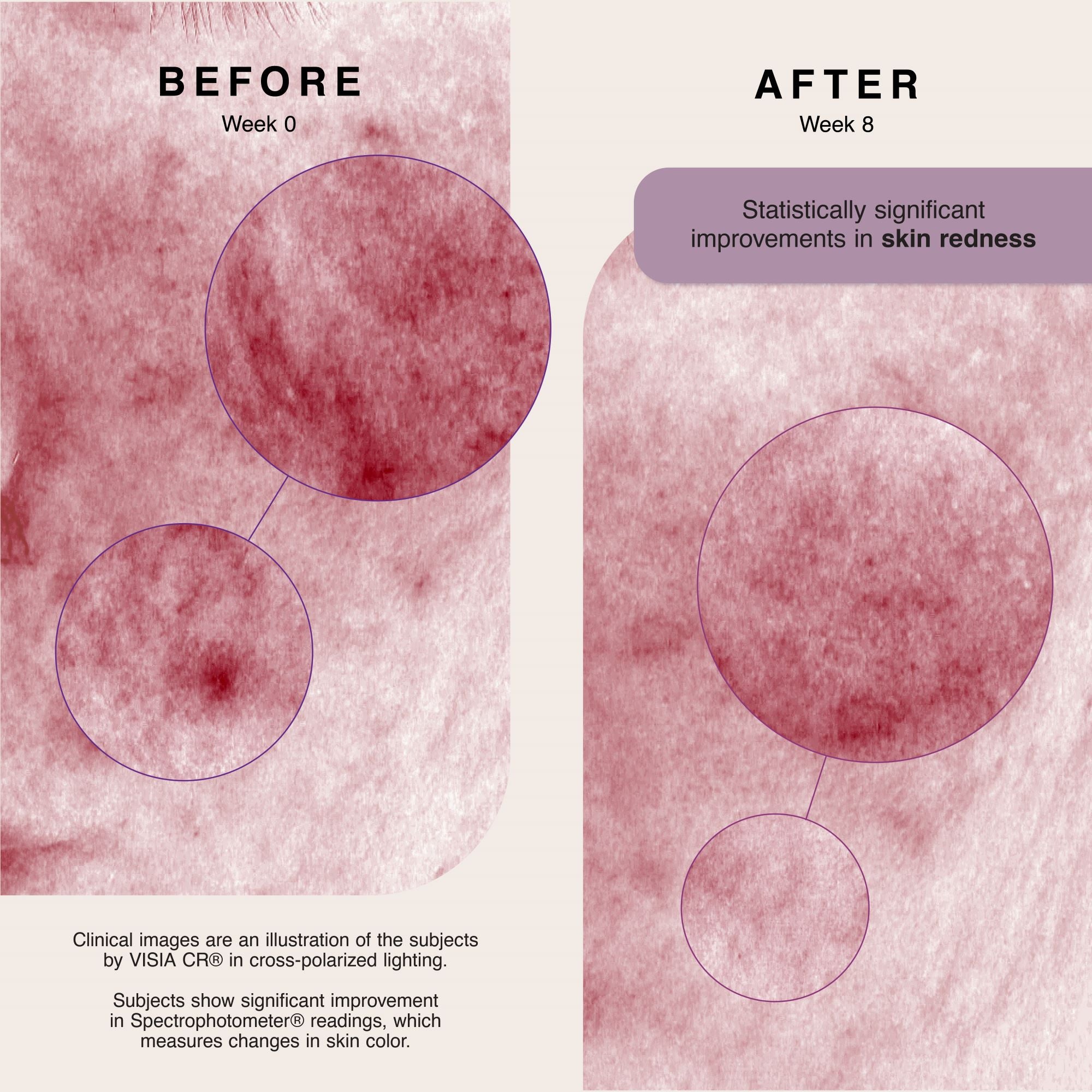 Before
Week 0
Clinical images are an illustration of the subjects by VISIA CR in cross-polarized lighting.
Subjects show significant improvement in Spectrophotometer readings, which measures changes in skin color.
After
Week 8
Statistically significant improvements in skin redness