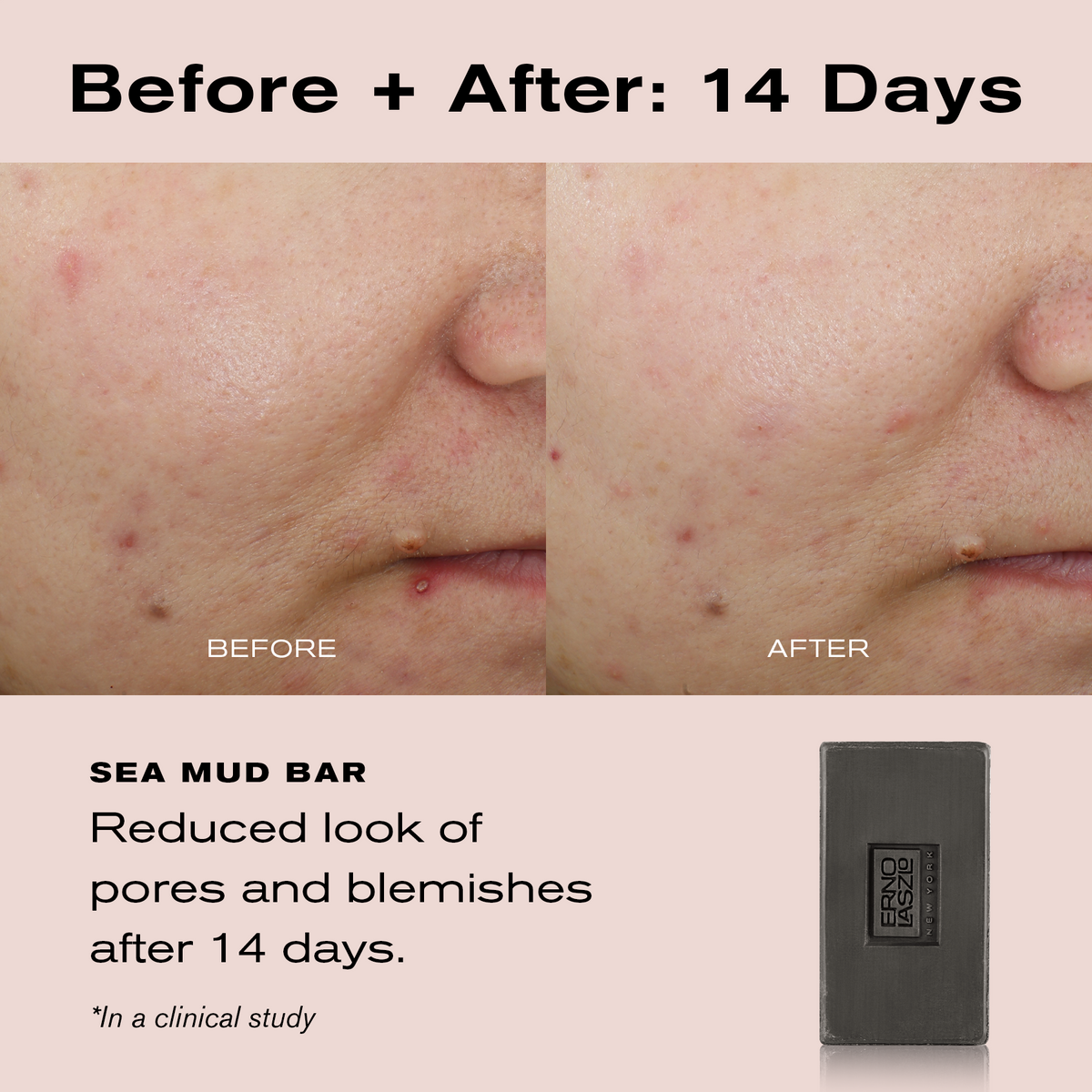 Before + After: 14 Days
Sea Mud Bar reduced look of blemishes after 14 days. 

*In a clinical study
